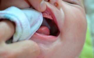 Стоматит у ребенка в 1 год: чем и как лечить