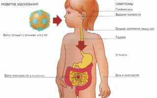 Лечение ротавирусной инфекции у детей