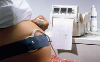 КГТ (кардиотокография) при беременности