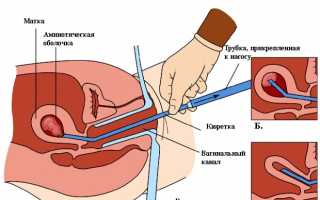 Вакуумный аборт (мини-аборт): этапы проведения процедуры и его последствия