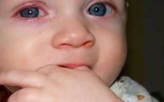 Почему у ребенка красные глаза: что делать