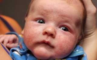 Аллергия у новорожденных: как выглядит и чем ее лечить