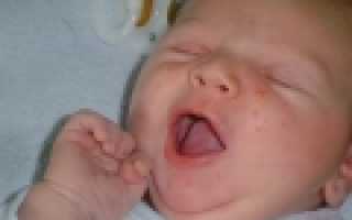 Прыщики у новорожденного на лице и теле