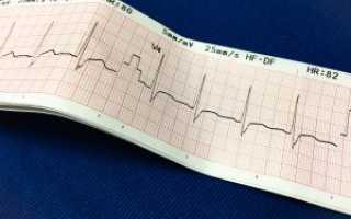 Расшифровка кардиограммы сердца