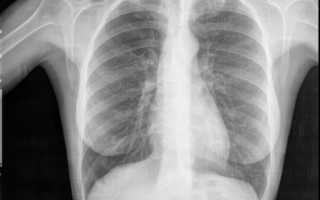Что показывает флюорография и особенности рентгена легких курильщика