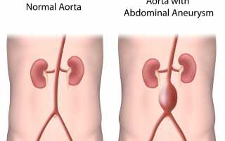 Аневризма аорты брюшной полости