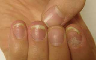 Псориаз ногтей — необычная разновидность