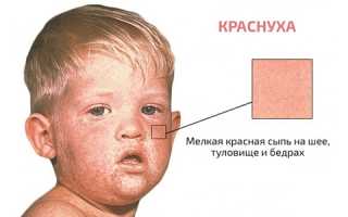 Краснуха у детей: симптомы, лечение и вакцинация