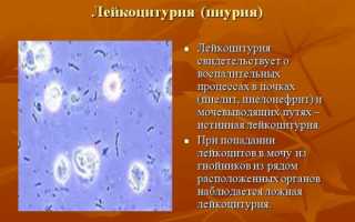 Повышенные лейкоциты в моче до и после родов (лейкоцитурия) – причины возникновения, методы лечения
