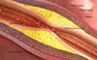 Окклюзия подключичной артерии