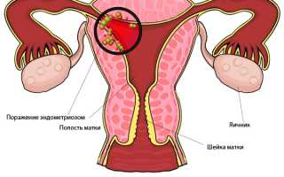 Эндометриоз после родов