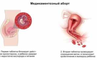 Аборт на ранних сроках – методы, особенности проведения, последствия